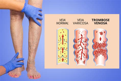simptomele trombozei varicoase tromboflebite acute